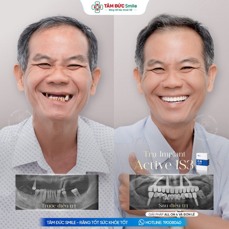 Hình ảnh trước và sau khi trồng răng Implant giúp phục hồi răng mất, cải thiện thẩm mỹ và chức năng ăn nhai tại Nha khoa Tâm Đức Smile