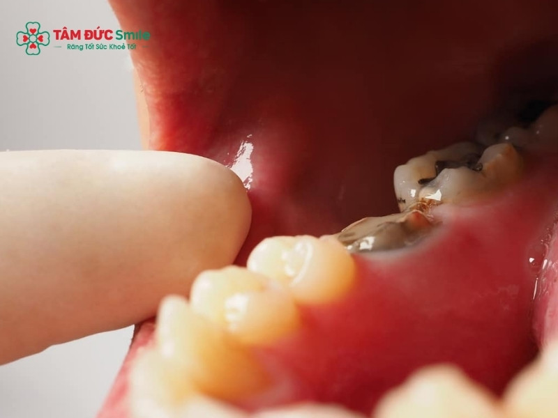 Nhổ răng đã lấy tủy có đau không? Khi nào cần nhổ và cách giảm đau