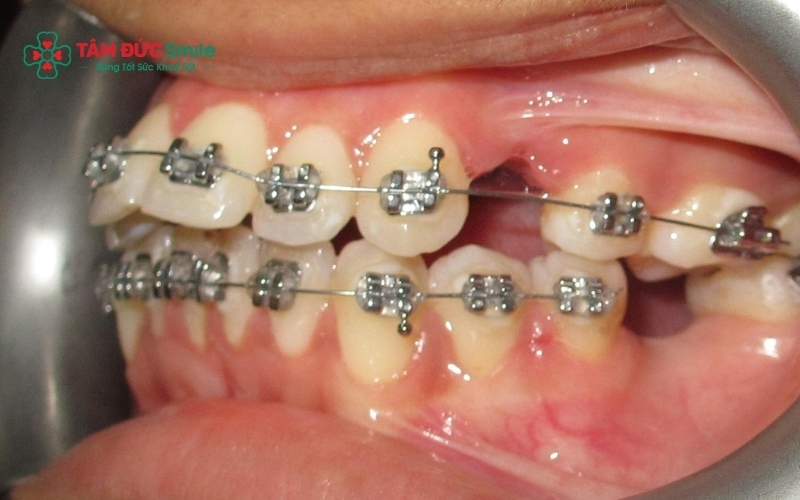 Niềng răng 5 năm có thể xảy ra trong một số trường hợp phức tạp, nhưng cần được đánh giá kỹ để tránh kéo dài không cần thiết