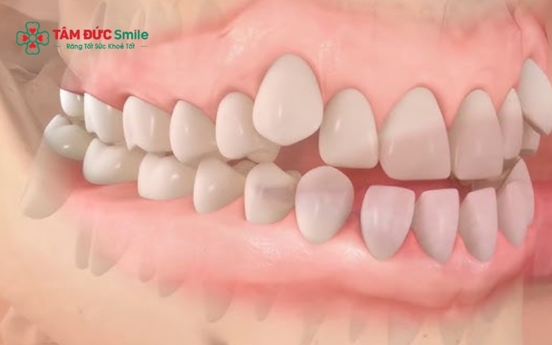 Những thay đổi trên khuôn mặt như môi tụt vào, mặt hóp có thể là dấu hiệu niềng răng bị cụp sớm