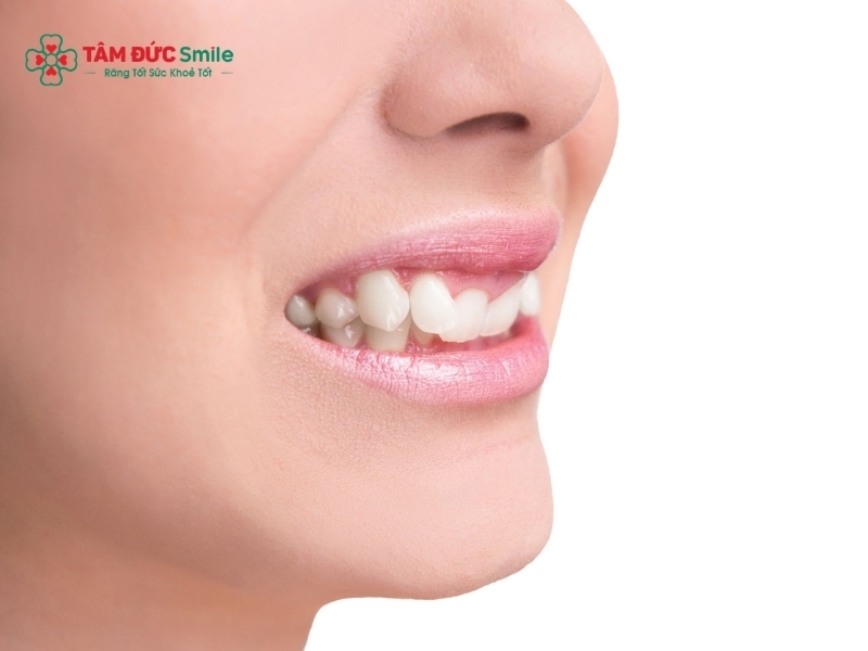 Niềng răng bị cụp: nguyên nhân, dấu hiệu và cách khắc phục an toàn