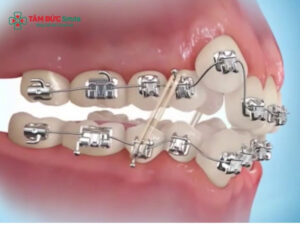 Niềng răng hô nặng: Chi phí, thời gian & phác đồ điều trị chi tiết