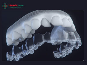 Niềng răng Invisalign có nhổ răng không? Khi nào cần nhổ