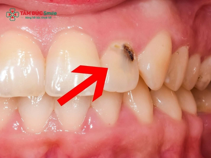 Răng nhai bị sâu: Dấu hiệu, nguyên nhân và cách điều trị hiệu quả