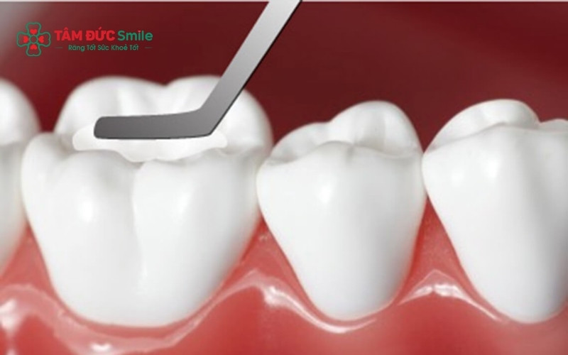 Vị trí răng số 6 bị sâu trên phim X-quang và tư vấn từ bác sĩ