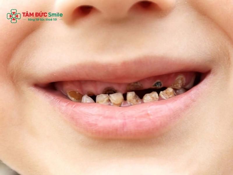 Răng sữa bị chết tủy: dấu hiệu, nguyên nhân và cách điều trị