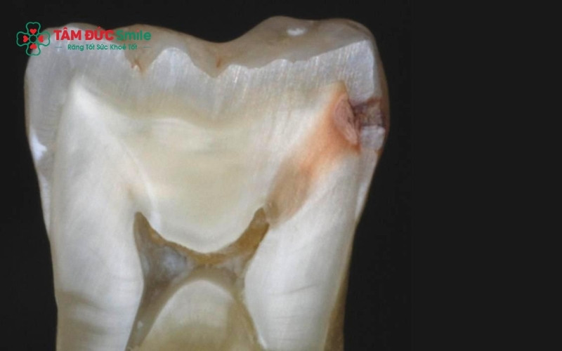 Sâu ngà răng xảy ra khi vi khuẩn đã vượt qua lớp men bảo vệ và bắt đầu phá hủy cấu trúc ngà răng bên trong