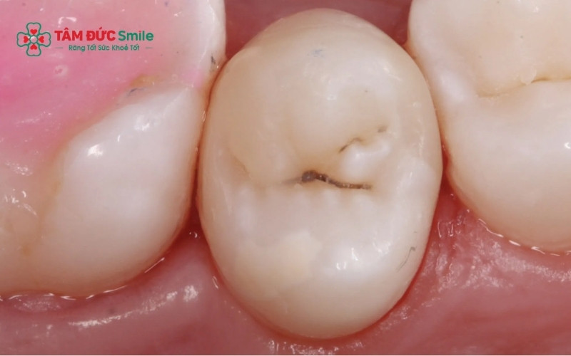 Răng xuất hiện lỗ hổng màu nâu hoặc đen kèm theo cảm giác ê buốt khi ăn đồ nóng, lạnh là dấu hiệu điển hình của sâu ngà.