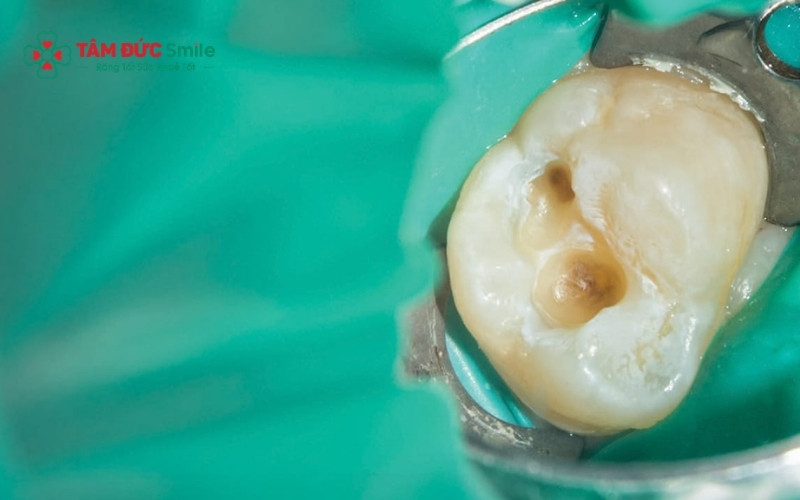 Mảng bám tích tụ và thói quen ăn nhiều đồ ngọt tạo môi trường lý tưởng cho vi khuẩn ăn sâu vào lớp ngà răng