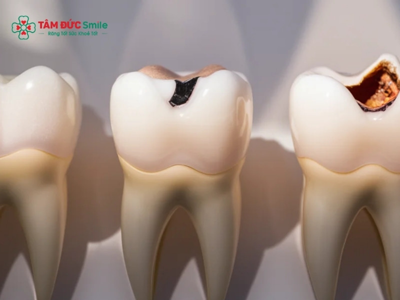 Sâu ngà răng là gì? Dấu hiệu, nguyên nhân và cách điều trị hiệu quả