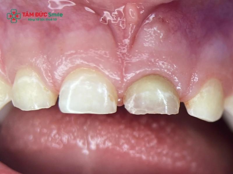 Đau răng kéo dài, răng đổi màu và nướu sưng là những dấu hiệu cảnh báo trẻ có thể bị thối tủy răng.