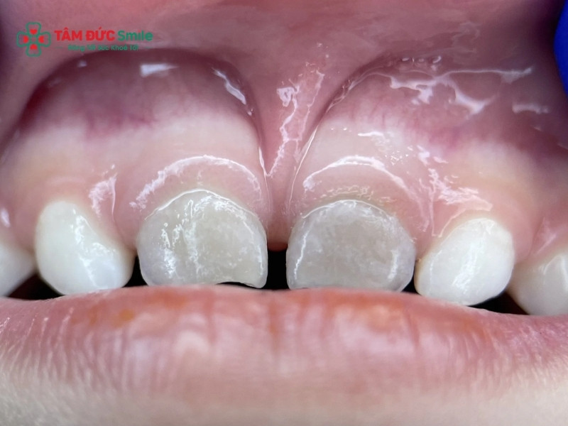 Sâu răng không điều trị kịp thời là nguyên nhân phổ biến khiến vi khuẩn xâm nhập và gây thối tủy răng ở trẻ.