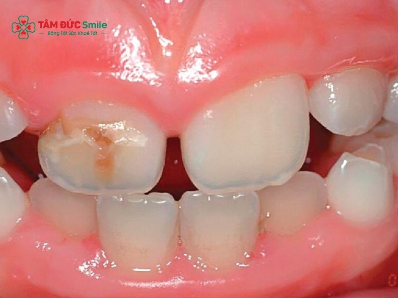 Trẻ bị thối tủy răng: Dấu hiệu, nguyên nhân và cách điều trị hiệu quả