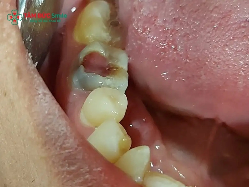 Viêm tủy răng có hồi phục: Dấu hiệu, nguyên nhân, cách điều trị sớm