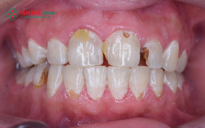 Những lỗ hổng màu đen hoặc nâu trên bề mặt nhai là dấu hiệu điển hình của sâu răng giai đoạn 2 và 3 cần được can thiệp nha khoa.