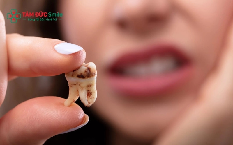  Khi sâu răng chạm đến lớp ngà và tủy, cảm giác đau nhức và ê buốt sẽ xuất hiện thường xuyên hơn do các dây thần kinh bị kích thích.