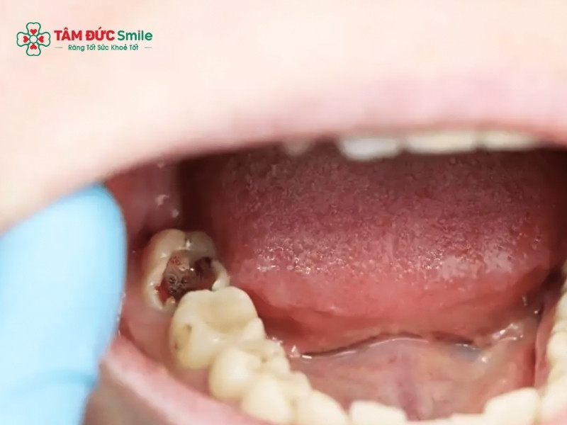 Các mức độ sâu răng: Dấu hiệu, phân loại và điều trị hiệu quả