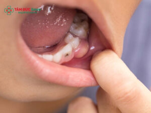 Chữa sâu răng cho trẻ 4 tuổi: Trám răng, điều trị tủy an toàn