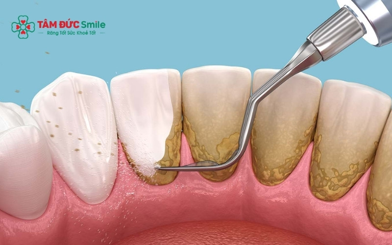 Các phương pháp tại nhà chỉ có tác dụng với mảng bám mới, không thể loại bỏ hoàn toàn cao răng lâu năm đã hóa thạch