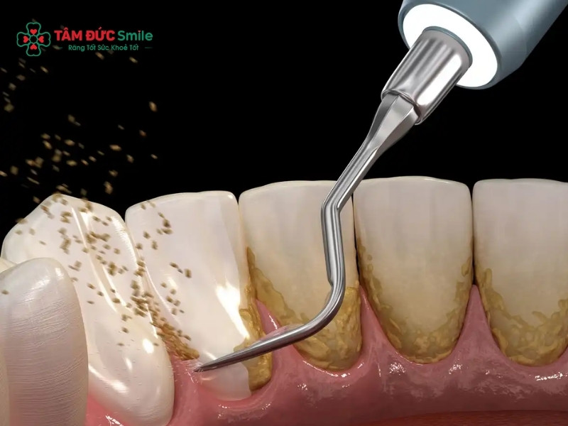 Cách làm rụng cao răng tại nhà và những lưu ý nên biết khi thực hiện cạo vôi răng tại nhà