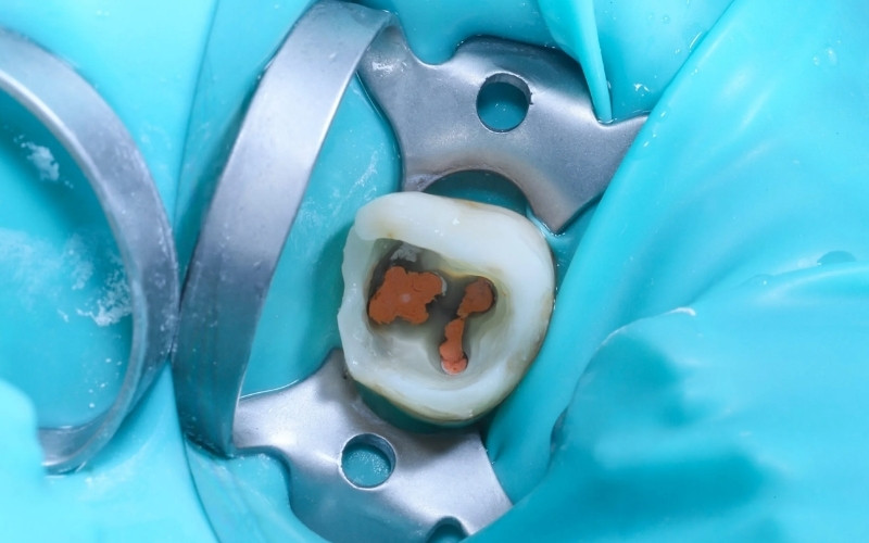 Các trường hợp sâu răng nặng, viêm tủy hoặc răng bị chấn thương đều được chỉ định điều trị tủy bằng máy để bảo tồn răng thật