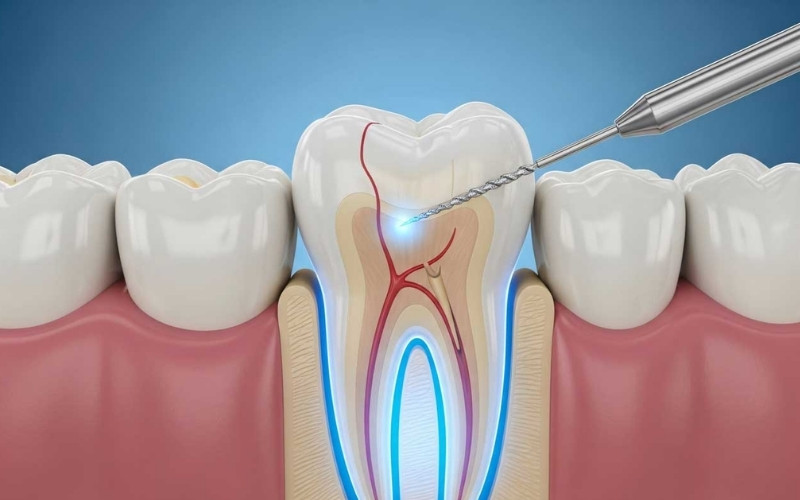  Điều trị tủy răng bằng máy sử dụng hệ thống trâm máy thông minh giúp làm sạch ống tủy một cách chính xác và nhanh chóng