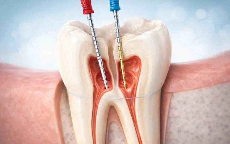 So với phương pháp truyền thống, điều trị tủy bằng máy giúp rút ngắn 1/2 thời gian và len lỏi vào các ống tủy cong một cách dễ dàng.