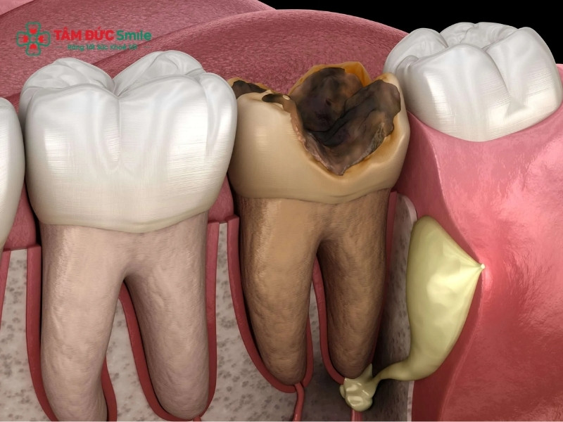 Nhiễm trùng tủy răng: dấu hiệu, nguyên nhân và điều trị hiệu quả