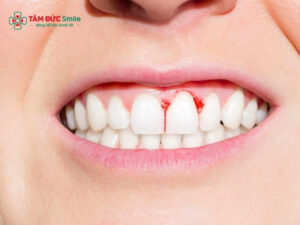 Nướu răng chảy máu: Nguyên nhân và cách điều trị