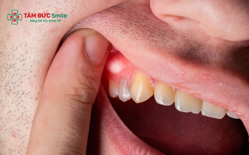  Đốm trắng trên nướu có thể xuất hiện dưới dạng chấm nhỏ li ti hoặc các mảng bám màu trắng đục tùy theo nguyên nhân.