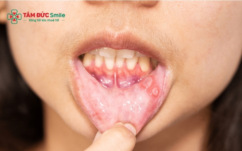 Nhiễm nấm Candida là một nguyên nhân phổ biến gây ra các mảng trắng bợn như sữa trên bề mặt nướu