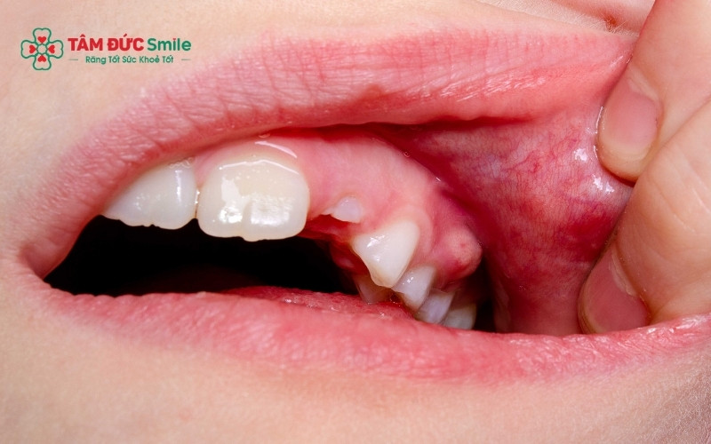 Những mảng trắng dày, cứng (bạch sản miệng) thường tiềm ẩn nguy cơ nguy hiểm và cần được bác sĩ kiểm tra ngay.