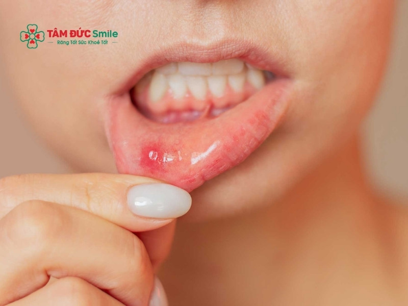 Nướu răng có đốm trắng là gì? Nguyên nhân và cách điều trị an toàn