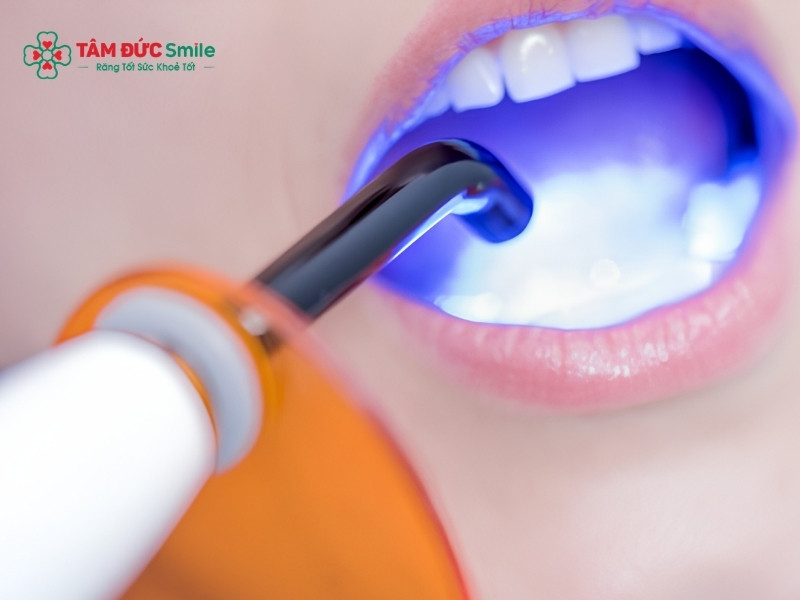 Ozon chữa sâu răng không đau, không khoan, an toàn hiệu quả cao