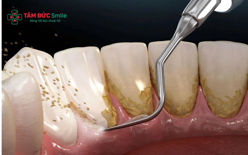 Cạo vôi răng bằng máy siêu âm là phương pháp nhanh chóng và hiệu quả nhất để loại bỏ hoàn toàn các vết đen ở mặt trong răng.