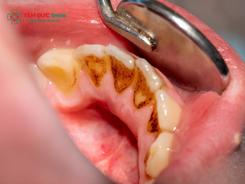 Các mảng bám cao răng đen tích tụ lâu ngày ở mặt trong là nguyên nhân phổ biến nhất khiến răng bị xỉn màu và đen ố