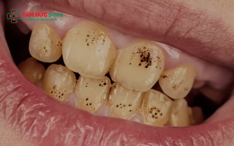 Thực phẩm có màu, thuốc lá và các mảng bám vi khuẩn là những nguyên nhân phổ biến khiến bề mặt răng xuất hiện các vết đen mất thẩm mỹ.