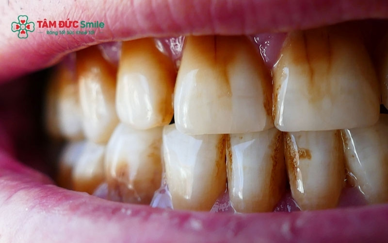 Các vết đen không chỉ gây mất tự tin khi giao tiếp mà nếu là dấu hiệu của sâu răng, chúng có thể phá hủy men răng nếu không điều trị kịp thời