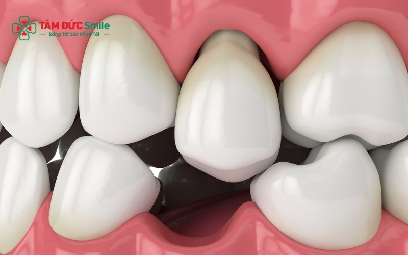 Việc giữ lại răng lung lay hay không phụ thuộc rất lớn vào mức độ tổn thương của mô nướu và xương hàm nâng đỡ quanh răng.
