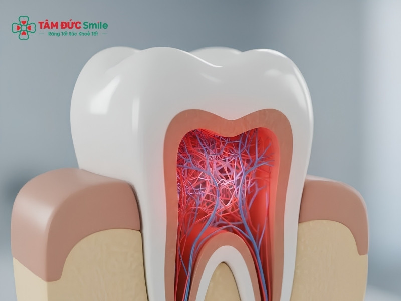Thuốc kháng sinh điều trị viêm tủy răng khi nào cần dùng?