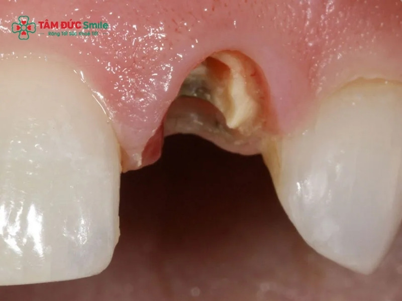 Tiêu chân răng là gì? Nguyên nhân, dấu hiệu và cách điều trị hiệu quả