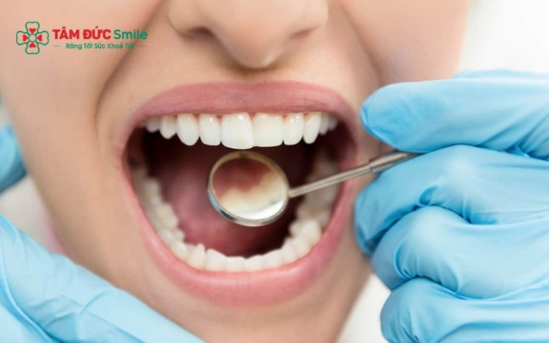  Tráng men răng được bác sĩ khuyên dùng cho các trường hợp men răng yếu, mòn cổ răng hoặc răng bị chấn thương nhẹ