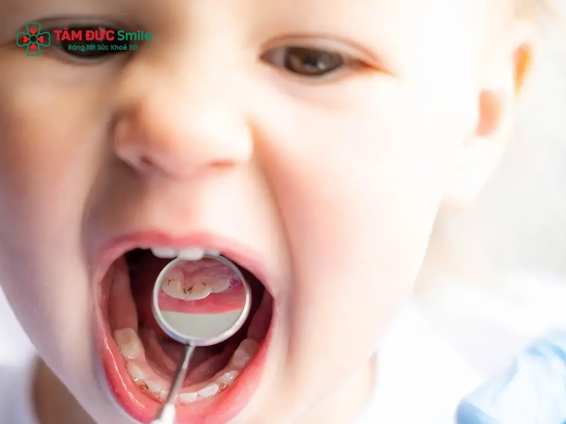 Trẻ 1 tuổi bị sâu răng: dấu hiệu, nguyên nhân và cách điều trị sớm