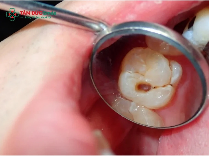 Viêm tủy răng có mủ: Dấu hiệu, cách điều trị dứt điểm an toàn