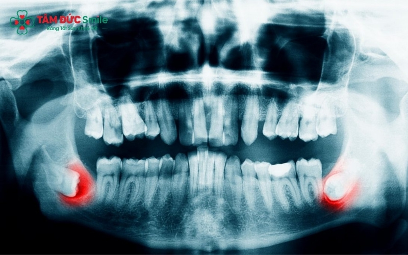 Phim X-quang là "chìa khóa" giúp bác sĩ xác định chính xác vị trí mầm răng khôn.