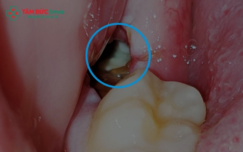 Răng số 7 mọc ở tuổi 12 thường bị lầm tưởng là răng khôn (răng số 8).