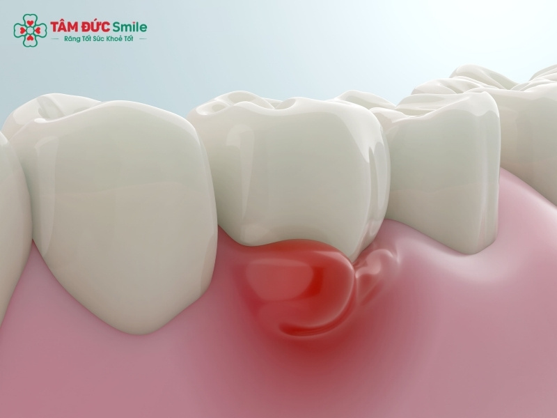 Bà bầu bị viêm chân răng phải làm sao để giảm sưng nướu?