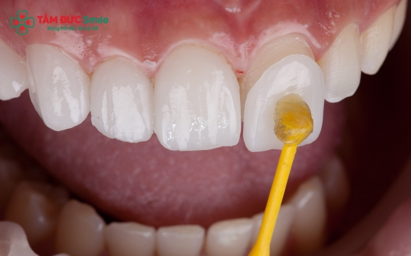 Hoàn toàn có thể bọc răng sứ cho 1 chiếc răng đơn lẻ để khắc phục các khuyết điểm mà không ảnh hưởng đến các răng lân cận.