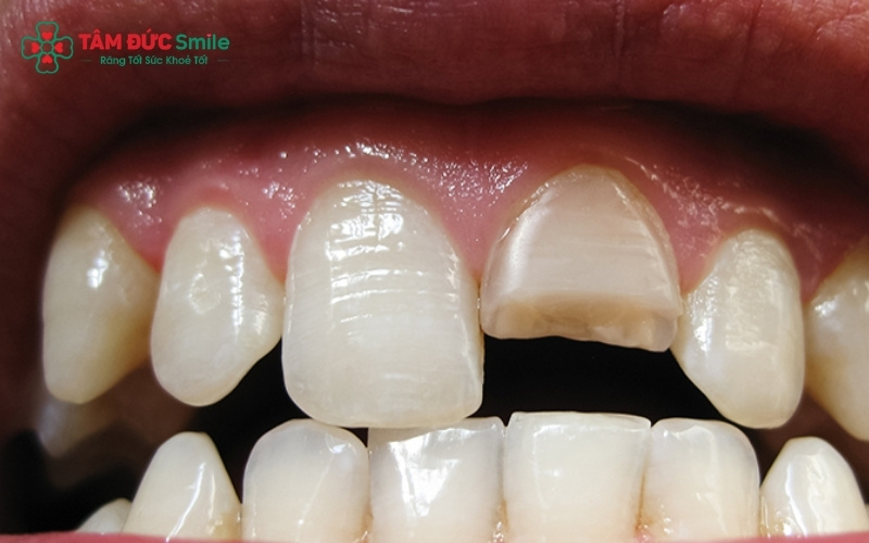 Bọc sứ là giải pháp tối ưu cho những trường hợp răng bị mẻ, vỡ lớn hoặc răng đã điều trị tủy cần được bảo vệ.