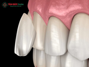 Bọc răng sứ 1 chiếc được không? Giá và quy trình cần biết